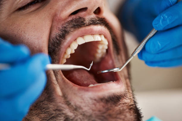 Best Knocked-Out Tooth (Avulsed Tooth) Treatment in Swartz, LA